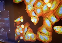 Cancer du cerveau: une avancée contre le glioblastome