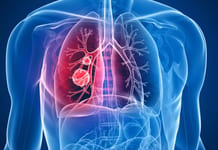 Cancer du poumon : les chances de survie augmentent de 58%