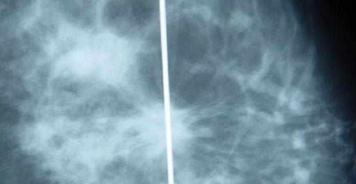 Nouveau-traitement-pour-le-cancer-du-sein