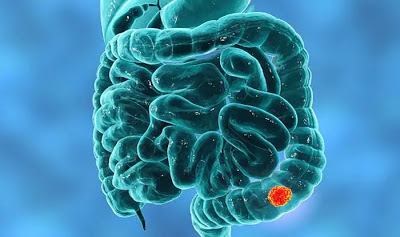 colon-cancer