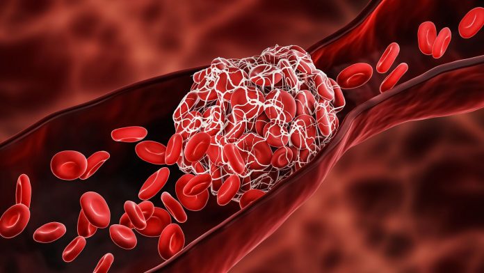 thrombose-les-signes-qui-doivent-alerter